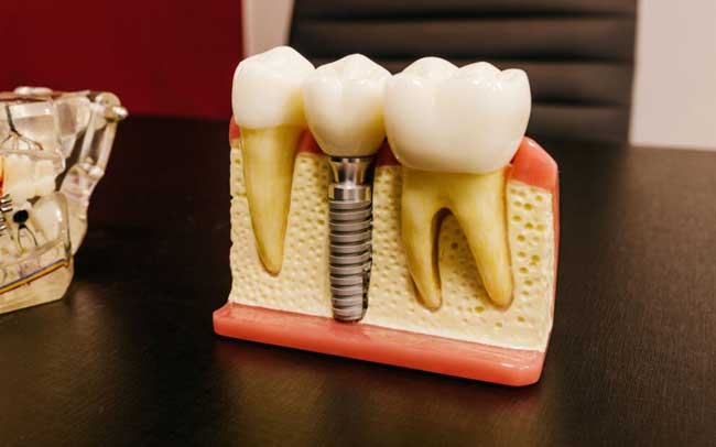 3D Dental Implant Dummy