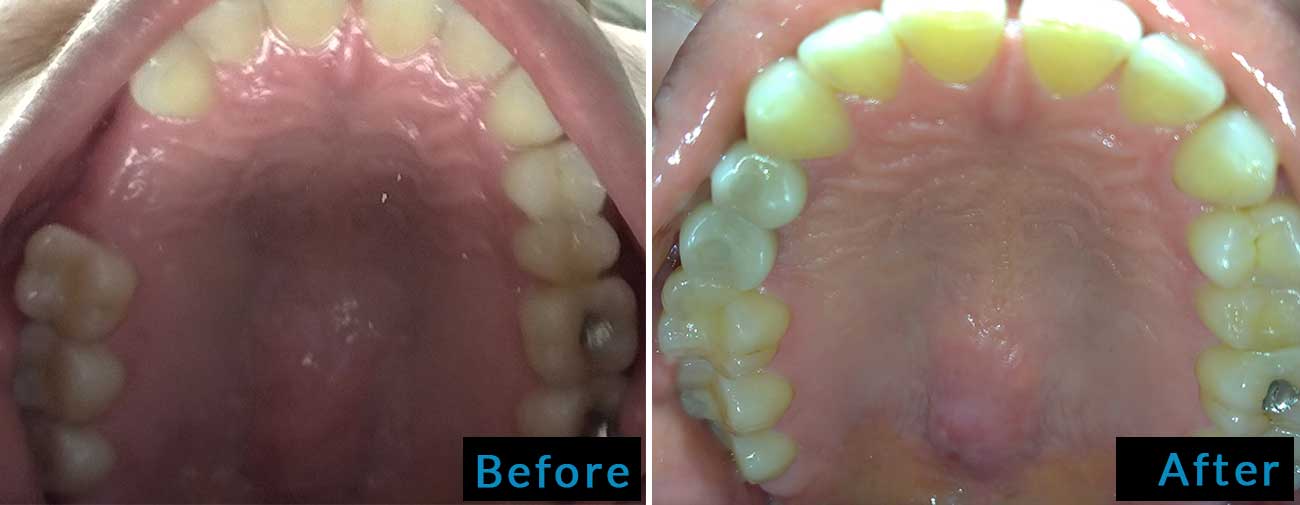 Dental Implant Before After 1