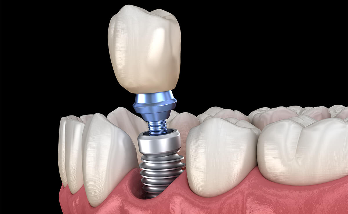Tooth Implant Surgery in Kanata ON Area