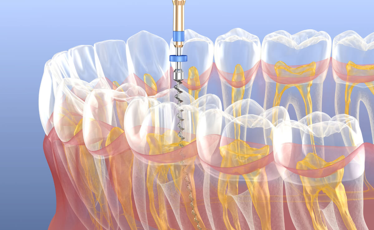 Painless Root Canal Treatment in Kanata ON area
